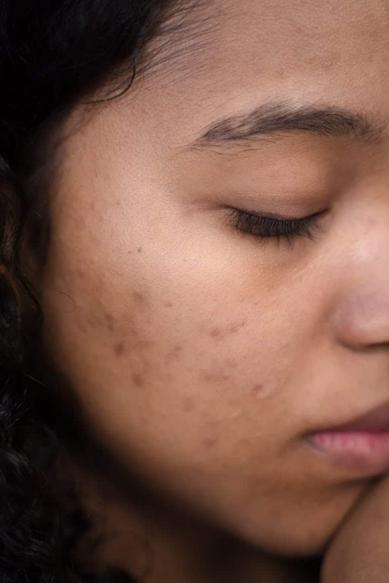Extreme close-up of a woman's face showing skin imperfections and calm expression.