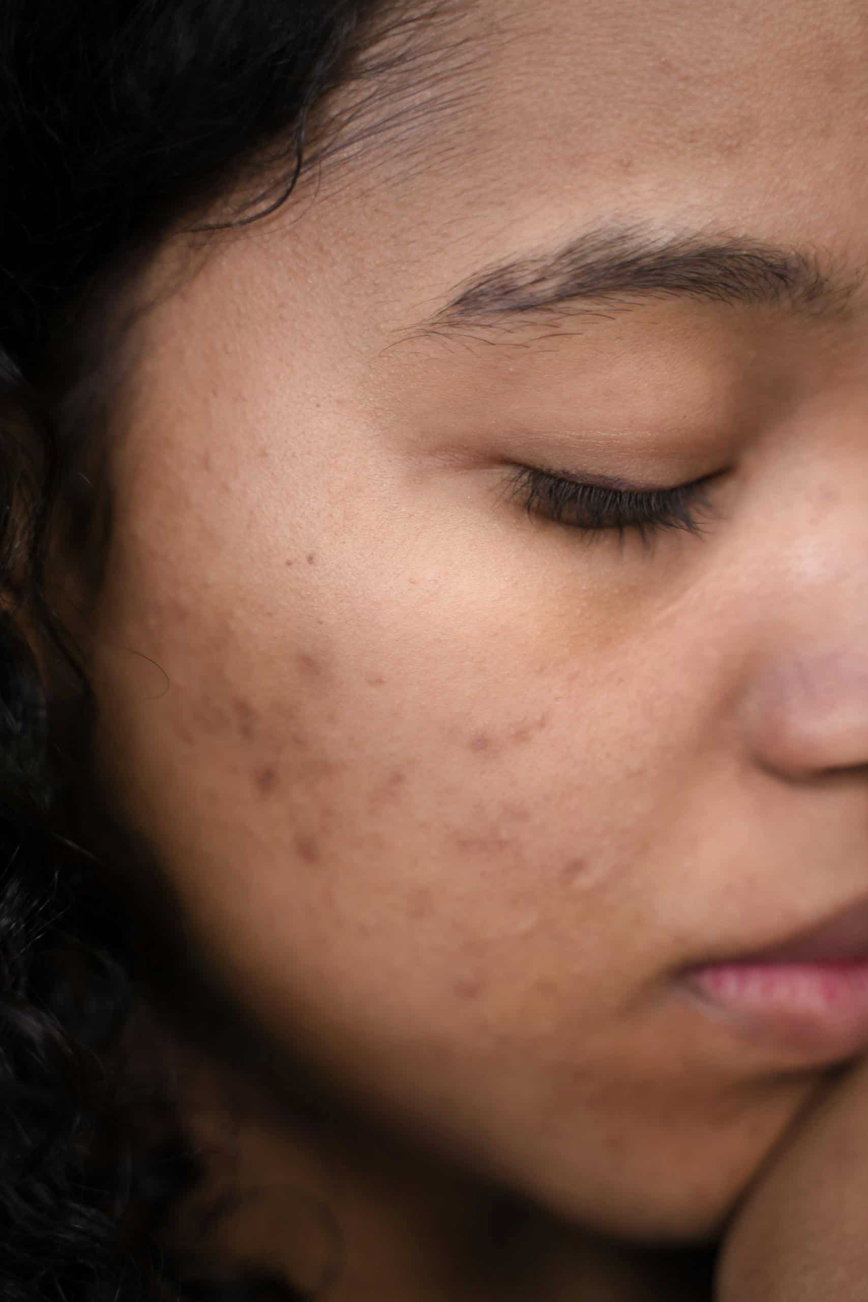 Extreme close-up of a woman's face showing skin imperfections and calm expression.